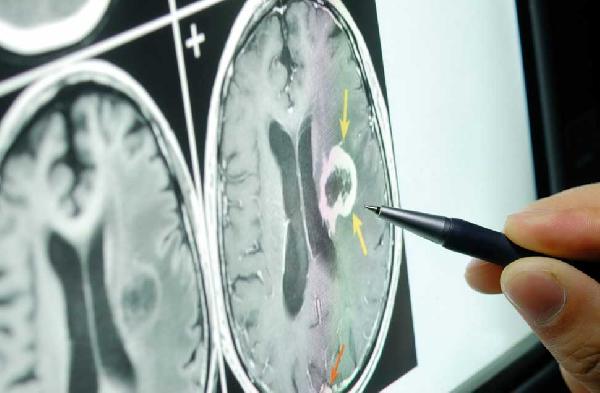 Stroke Mematikan, Perangilah!